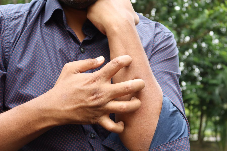 Infected Insect Bite Treatment at Alisha Pharmacy