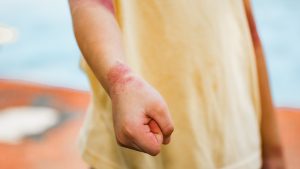 Infected Insect Bite